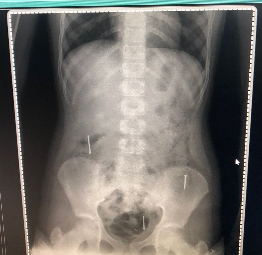 Niña de 10 años ingirió tres clavos por “reto de TikTok”