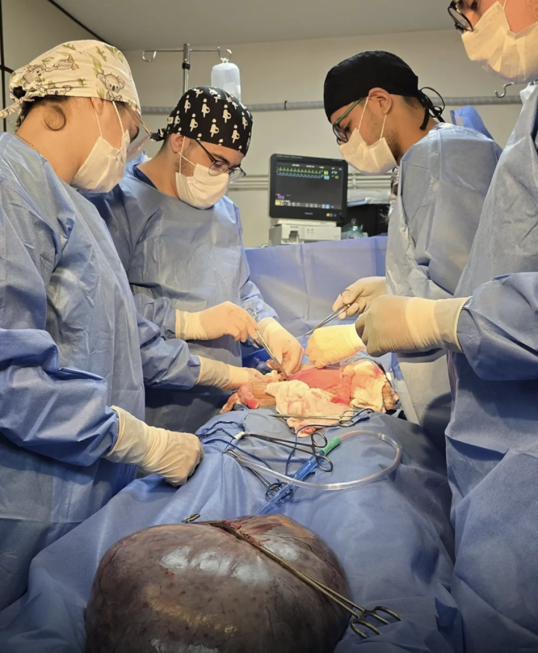 Hospital Central del IPS extirpa quiste de casi 8 kilos a embarazada de 31 semanas