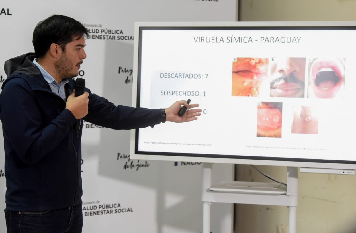 Vigilancia de la Salud pide estar alerta ante viruela símica