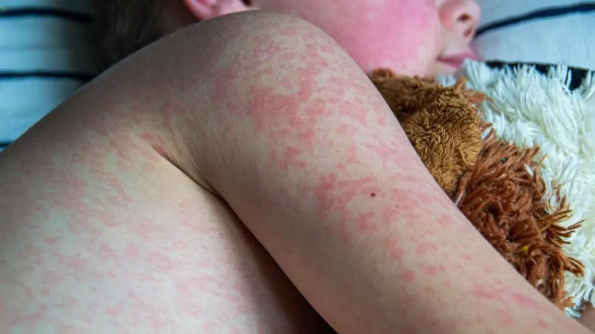 Nueva York declara emergencia sanitaria por sarampión